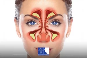 علاج الجيوب الأنفية
