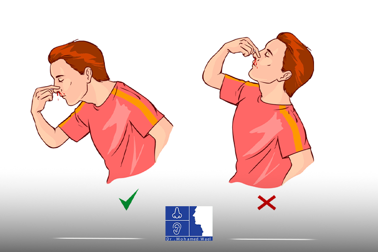 علاج نزيف الانف