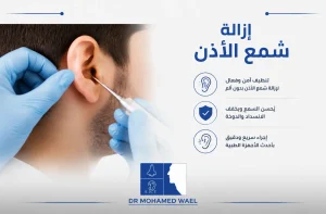 إزالة شمع الأذن